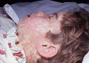 Antibiotic side-effect Steven Johnson's Syndrome
