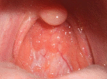 Picture of normal teenage throat, tonsils have melted away, post nasal drip